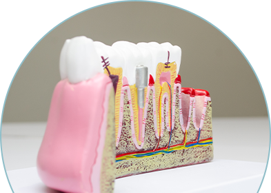dental-implants